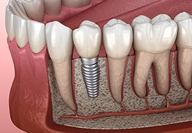 single dental implant with crown in the jawbone