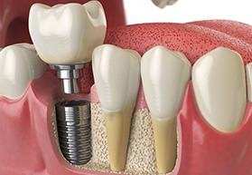dental implant post with abutment and crown being placed in the jaw 