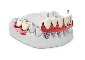 a computer illustration of a permanent partial implant denture being placed in a mouth