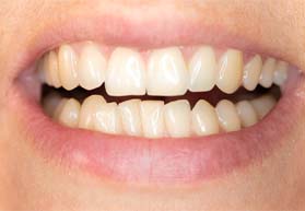 Closeup of crowded teeth in Annapolis before Invisalign