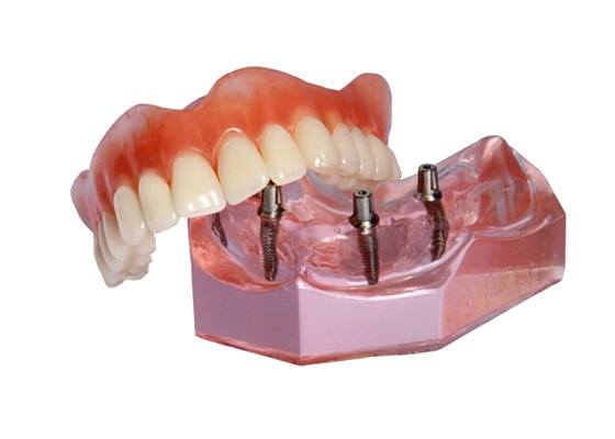 A model of an implant-retained denture.