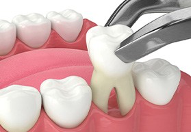 Digital image of a tooth extraction