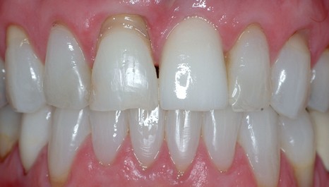 smile 16 after