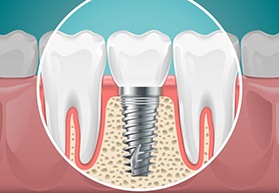 dental implant post in the jawbone