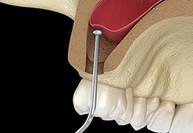 sinus lift procedure in the upper jaw 