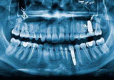dental implant special