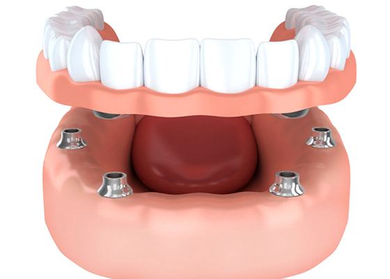 A diagram of an implant-retained denture.