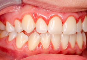 Up-close view of gums affected by bacterial accumulation 