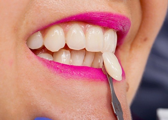 Closeup of patient getting veneers in Annapolis