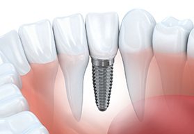 Single dental implant in the lower arch