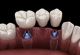 Dental bridge about to be attached to implants