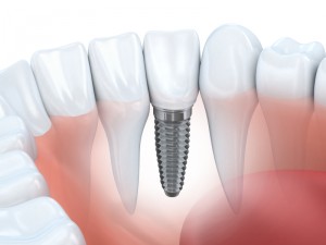 dental implants in annapolis