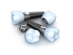 dental implants in Annapolis