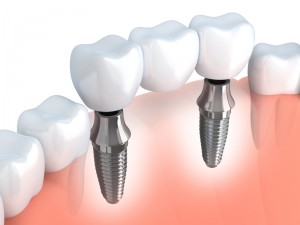 dental implants in Annapolis