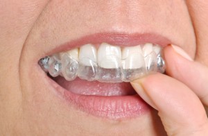 invisalign in annapolis is a perfect gift