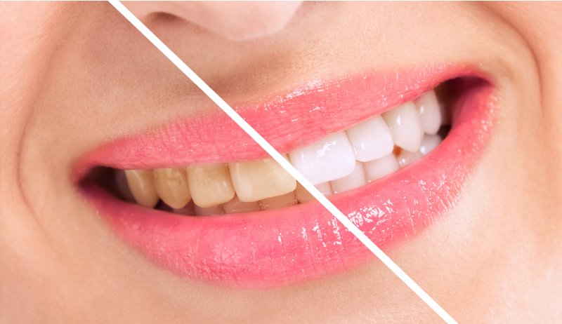 teeth whitening before and after