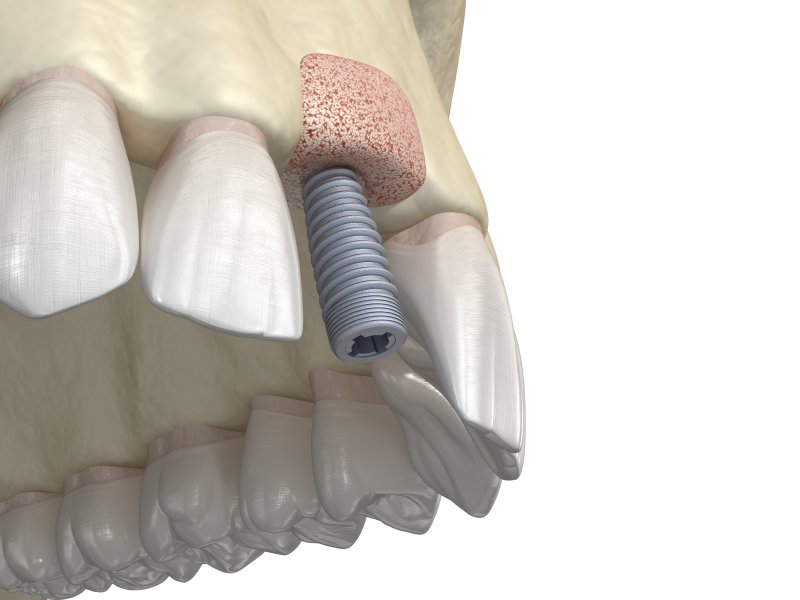 Bone graft in Annapolis