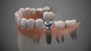 3D drawing of a dental implant