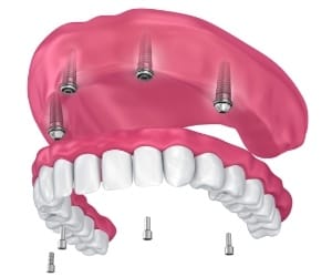 Model of implant-retained dentures in Annapolis. 