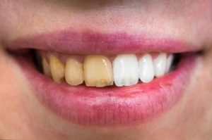 Teeth whitening results from cosmetic dentist.