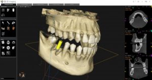 a 3D image taken with a CBCT scanner