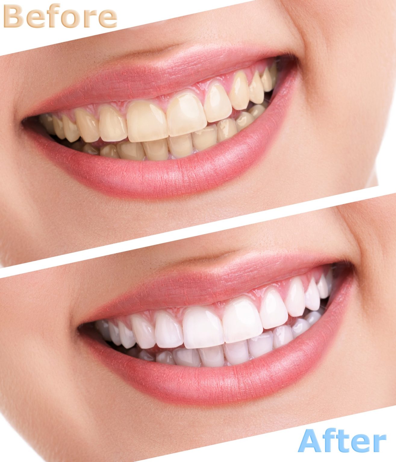 how-to-whiten-bonded-teeth-in-annapolis-for-a-brighter-smile