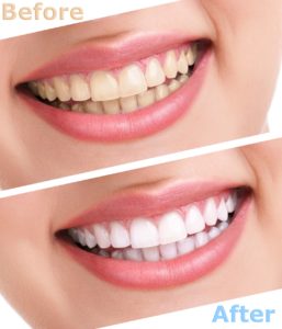 Before and after whitening bonded teeth in Annapolis