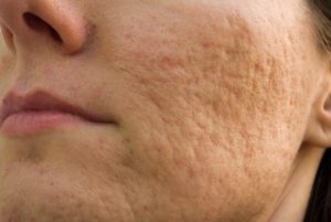 a closeup of a person with acne scarring
