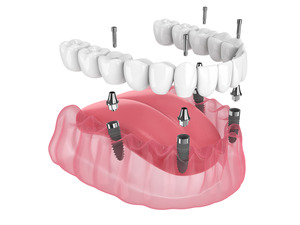 Illustration of dentures and dental implants being placed