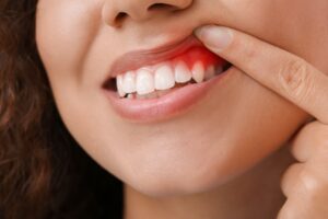 Woman checking her mouth and seeing noticeably red gums